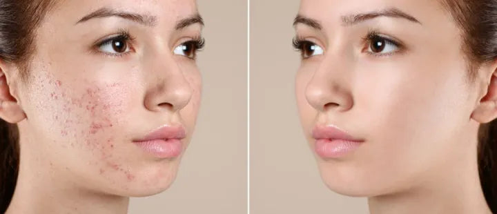 Skin-A Cream 10g