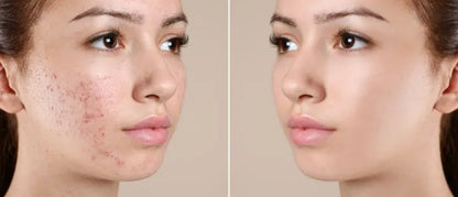 Skin-A Cream 10g