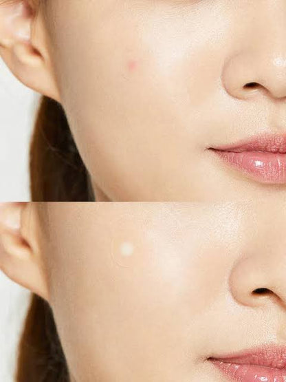 Cosrx Acne Pimple Patch 24 Patches