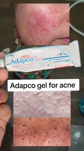 Adapco 0.1% Gel (15g) Original Acne & Black Spot Treatment